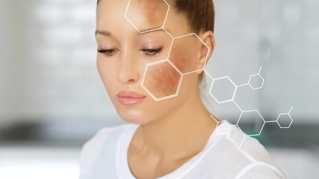 Melasma y manchas en la piel: causas, prevención y mejores tratamientos