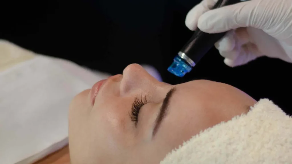 Puntos negros y cómo decirles adiós con Hydrafacial
