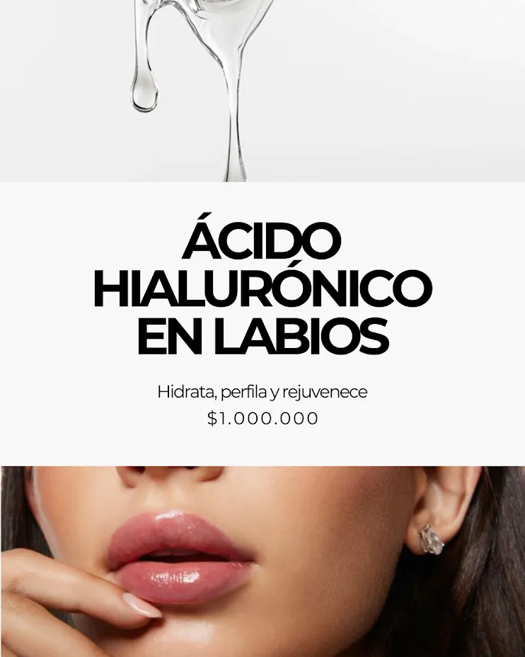 Ácido hialurónico en labios